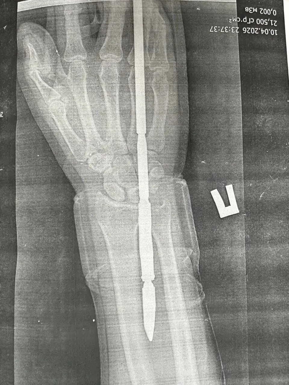 Орский рыбак случайно выстрелил в себя из подводного ружья